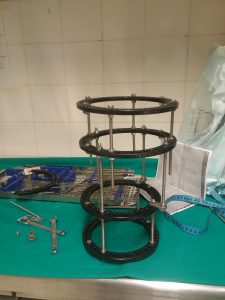 Εξωτερική Κυκλοτερή Οστεοσύνθεση (ILIZAROV)