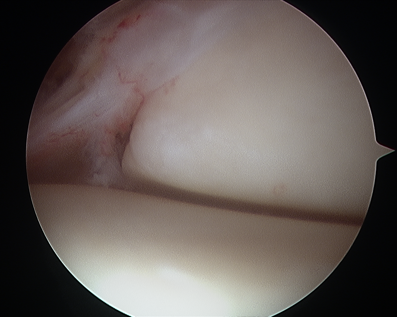 αρθροσκοπηση ποδοκνημικής