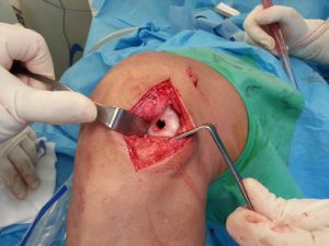 αυτομεταμοσχευση χόνδρου