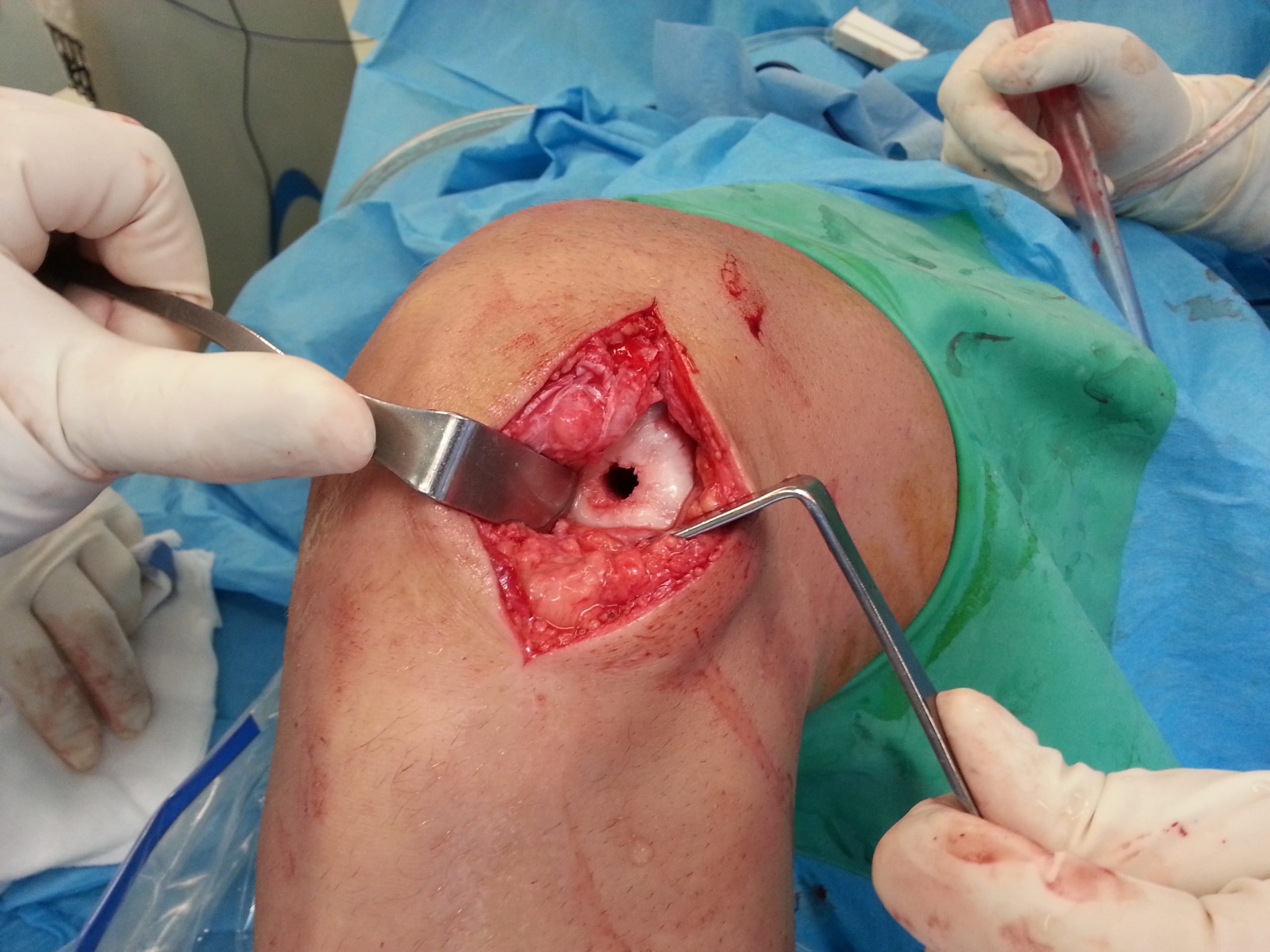 αυτομεταμοσχευση χόνδρου